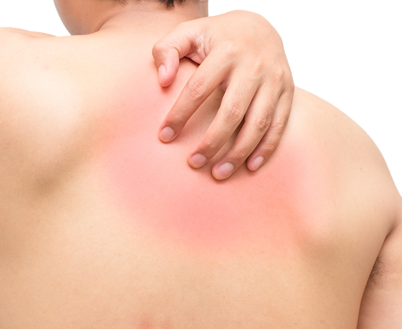 common-allergy